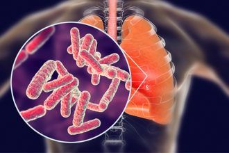 ilustrasi TBC pada anak