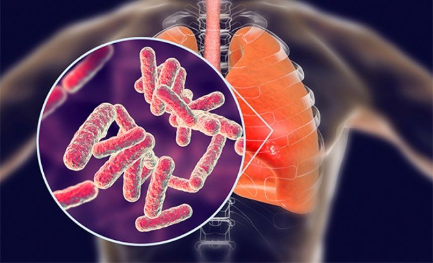 ilustrasi TBC pada anak